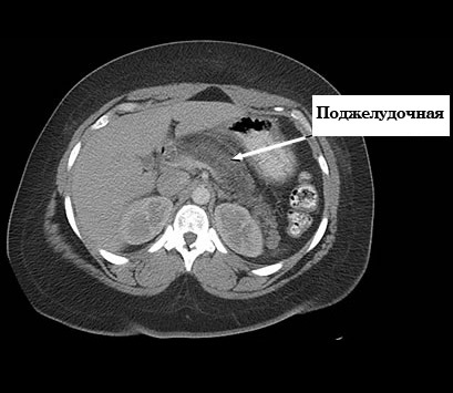 МРТ снимок поджелудочной железы­